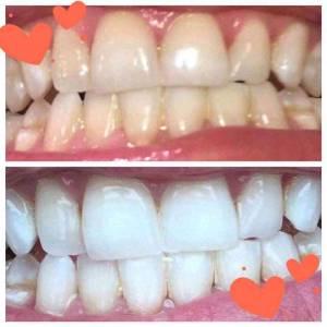 diy teeth whitening