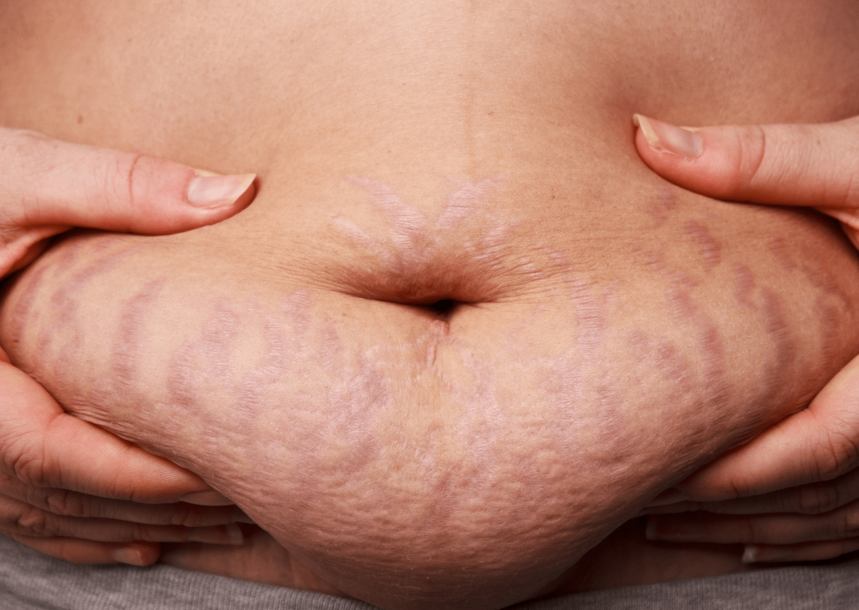 post pregnancy belly